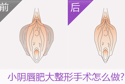 小阴唇整形术前注意事项