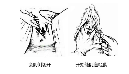 会阴切开术术后护理要点