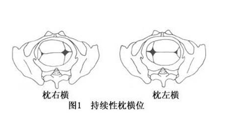枕横位的原因